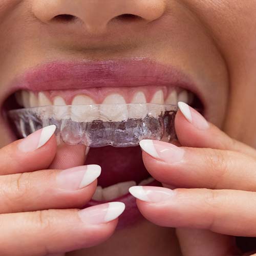 Invisalign-1-stomer Dental-Prostheses-stomer-2