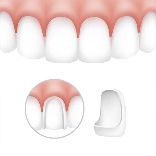 dental-veneers-stomer-2