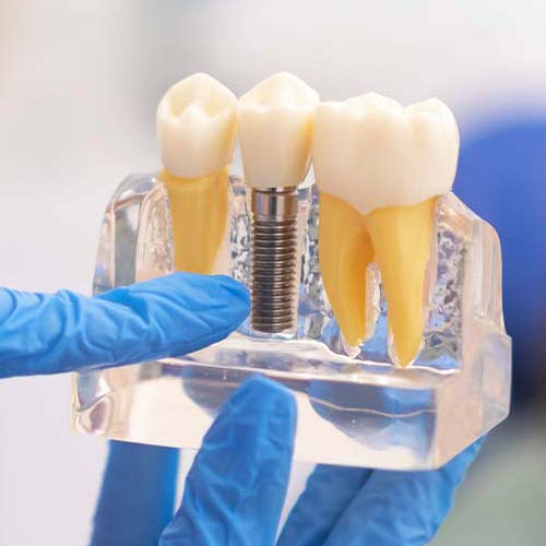 dental-implant-stomer-1 dental-implant-stomer-1