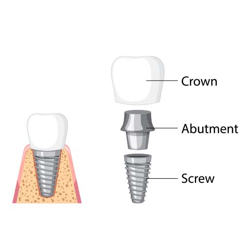dental-implant-stomer-2 dental-implant-stomer-2